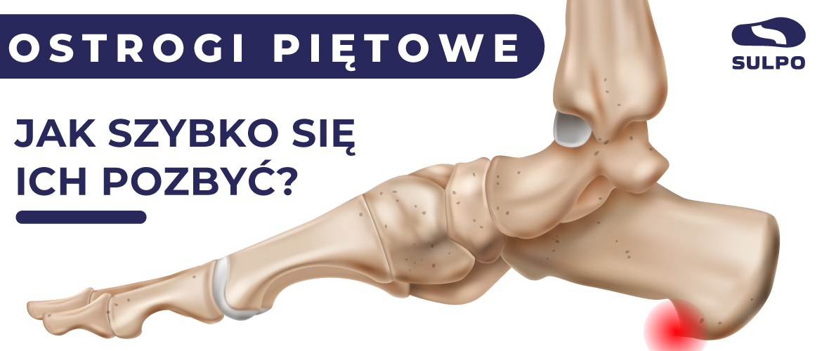 Ostrogi piętowe - Jak szybko pozbyć się ostrogi piętowej?